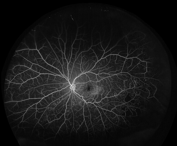 P200Tx-Projected-Retinal-Vein-Occlusion-FAOcclusion19